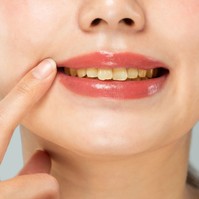 6 étel és ital, amitől elszíneződhetnek a fogai