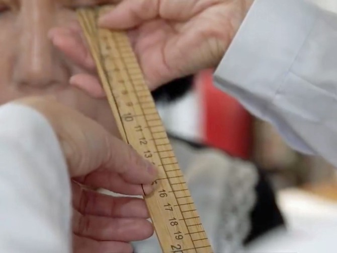 Ženi (58) trepavice porasle preko 20 centimetara: Lekari bez teksta gledali u nalaze