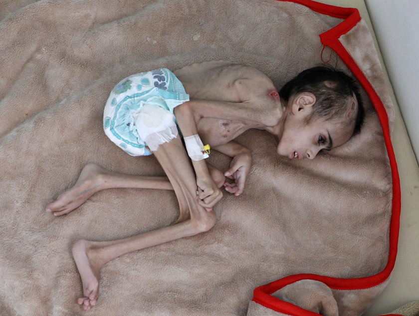Ma siedem lat i waży 7 kg. Ten horror dzieje się na naszych oczach, głód zabił już kilkadziesiąt tysięcy dzieci