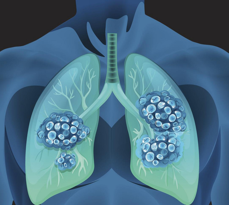 Kwas dichlorooctowy uruchamia mechanizm apoptozy w komórkach rakowych