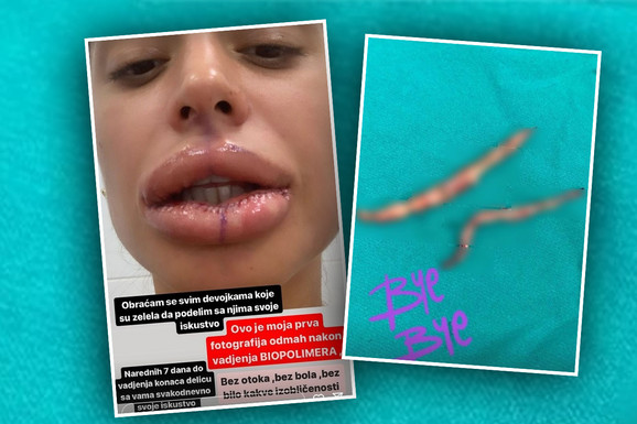 (FOTO) "OBRAĆAM SE SVIM DEVOJKAMA" Šok slike zadrugarke nakon vađenja silikona iz usana: "Zar ti je to bilo u ustima?"