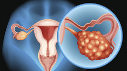 Fatalna wykrywalność raka jajnika w Polsce. Zachorowalność rośnie, większość chorych umiera
