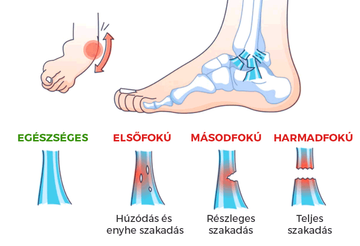 A boka belső oldalán található szalag (deltoid ligament) három része osztható. A szalag két rétegben fut, a mélyebben fekvő réteg kulcsfontosságú. Ez a bokaszalag akkor szakad elbokaszalag sérülés - fájdalomközpont általában, amikor a bokacsontok súlyos törése következik be.