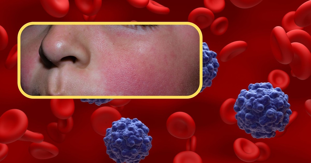 "Piąta choroba" u dzieci. Tych objawów nie bagatelizuj Wiadomości