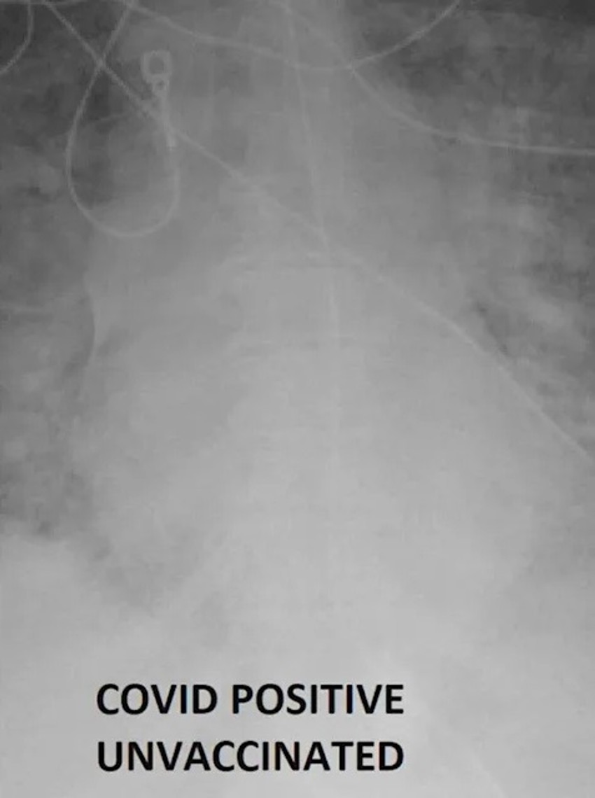 Rendgenski snimak nevakcinisanog pacijenta obolelog od kovida