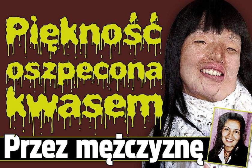 Piękność oszpecona kwasem. Przez mężczyznę