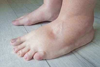 Ödémás láb: innen tudhatja, hogy szívprobléma okozza