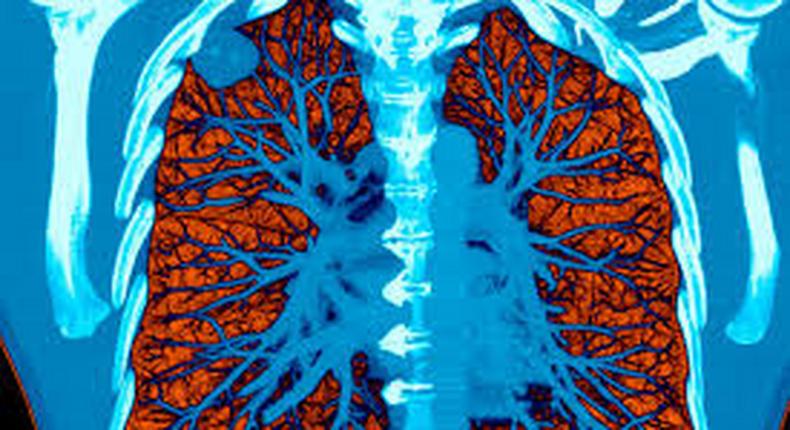 AI took a test to detect lung cancer, it got an A