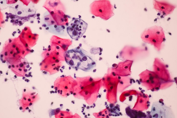 HPV vírus: hogyan lehet elkapni?