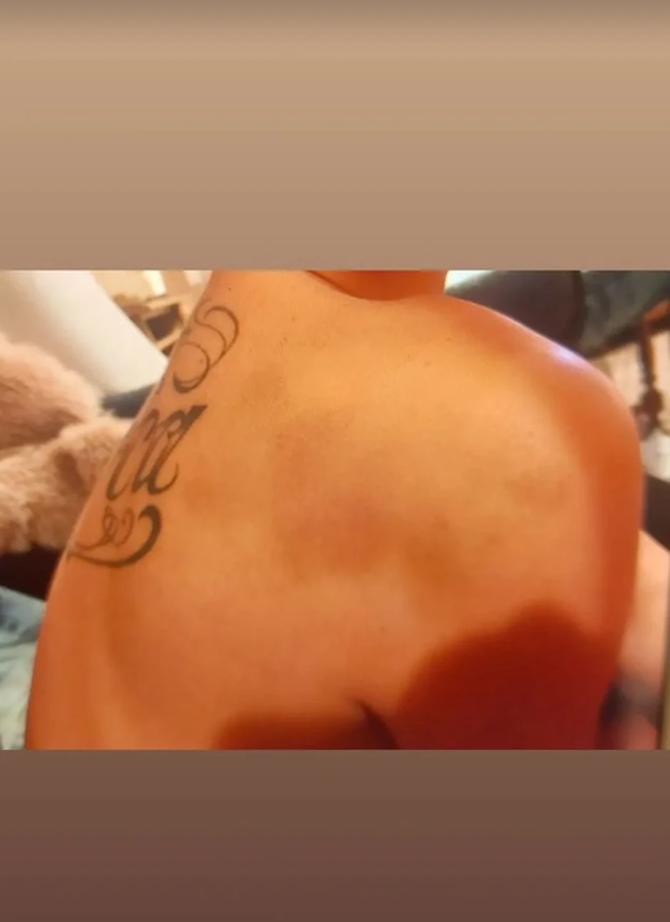 Maji telo puno modrica