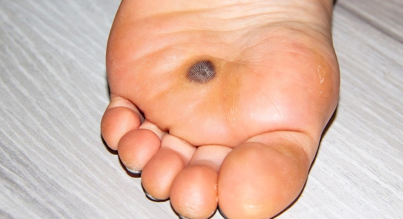 Plantar warts show up on the soles of your feet.Olga Vynnychenko/Getty Images