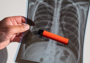 Kokičasta pluća najčešće nastaju kod korisnika koji se izlažu određenim hemikalijama