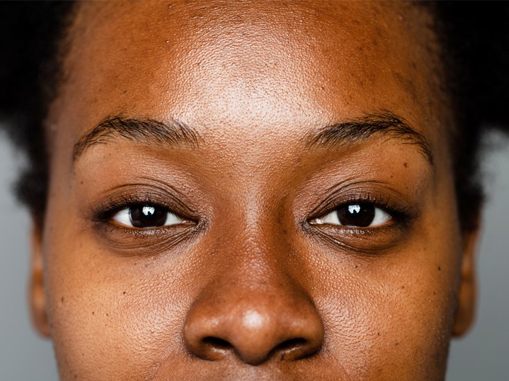 Sunburn causes hyperpigmentation [Healthline]