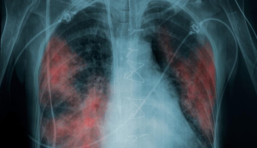 Tuberkulózis (tbc) tünetei és kezelése - HáziPatika