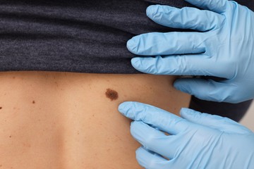 agresszív melanoma bőrrák tünete jele felismerése