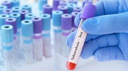 sanepid potwierdza: uczeń krakowskiej szkoły zachorował na gruźlicę. t