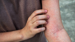 The rash may be a sign of a coronavirus.  What to worry about? [WYJAŚNIAMY]