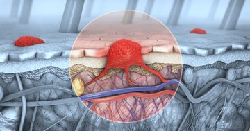 Így néz ki a melanoma.