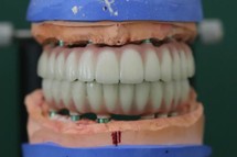 Ponad 4000 zł na nowoczesną protezę zębową do wzięcia w 2026 r. – wyczekiwane świadczenie przysługujące w związku z zarządzeniem Prezesa NFZ