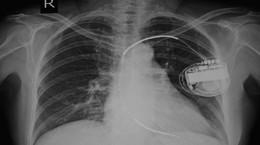 Kardiowerter – urządzenie ratujące chore serce