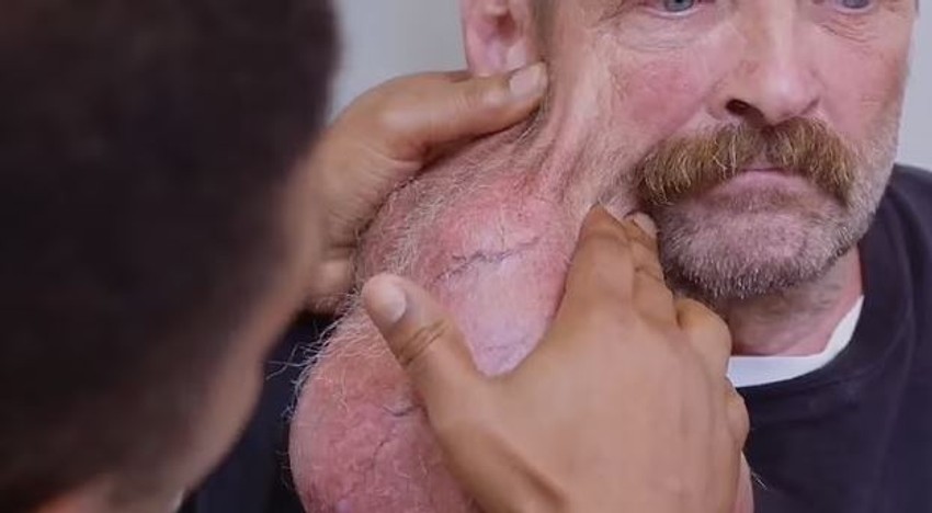 Tumor koji je Tim imao godinama na licu