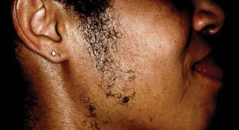 Facial hair home remedies