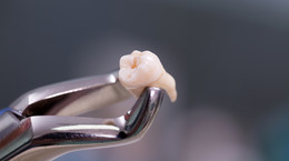 Kiedy odpada skrzep po wyrwaniu zęba? Ważne porady stomatologa