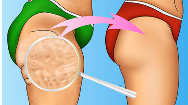 Jak się pozbyć cellulitu raz na zawsze? To naprawdę działa! [INFOGRAFIKA]