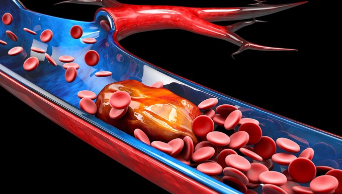 Így előzheti meg a szívelégtelenséget és a stroke-ot