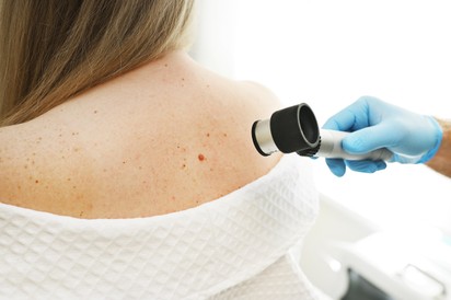 Melanómát diagnosztizáltak? Ezeket a kérdezze meg az orvosától