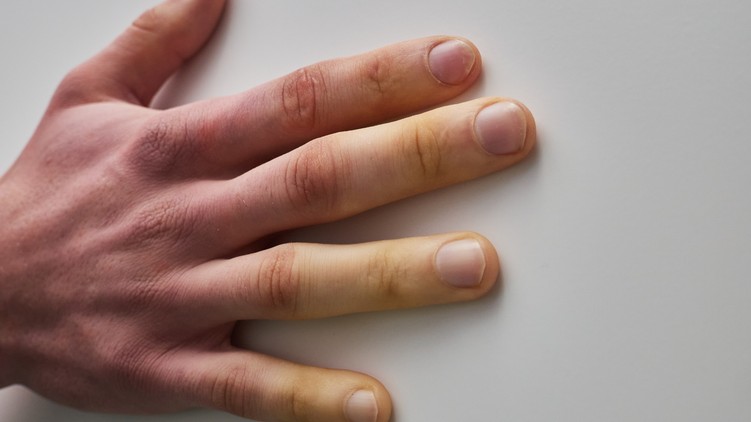 hideg ujj scleroderma Raynaud-szindróma tünetei