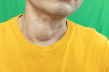 Mikor kell műteni a strúmát? Az endokrinológus válaszol