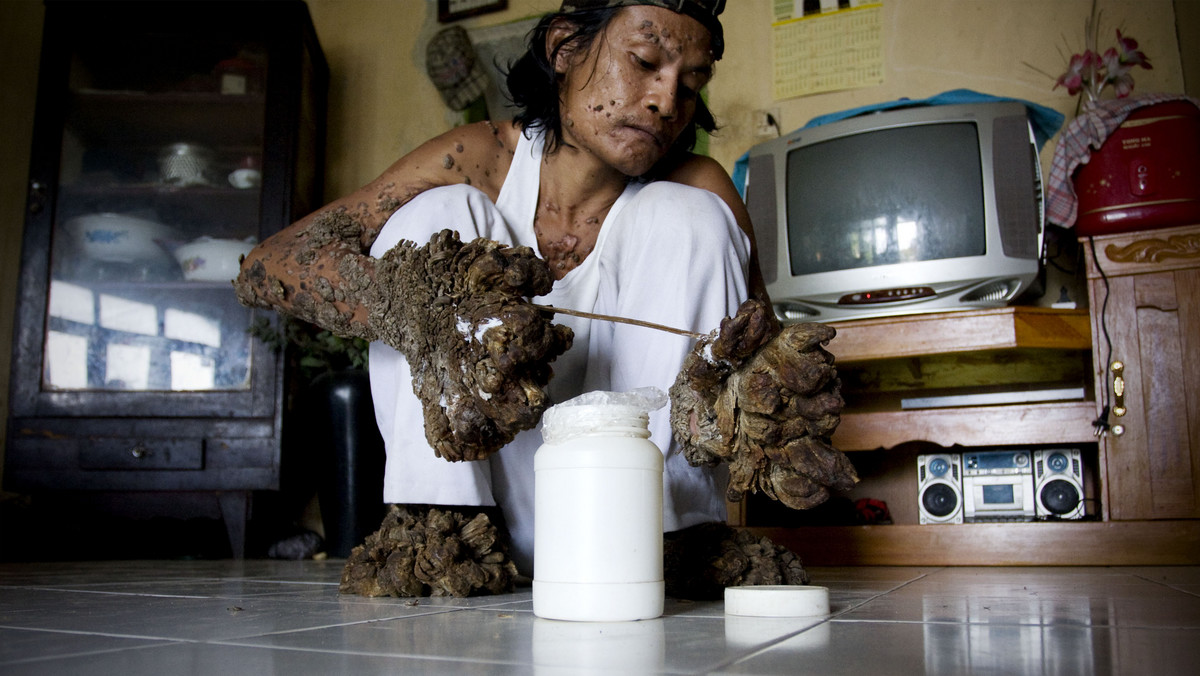 Indonezyjczyk Dede Koswara znany jako "człowiek-drzewo" zmarł po długiej walce z nieuleczalną i rzadką chorobą w skutek, której jego ciało było pokryte łuszczącymi się brodawkami. Miał 42 lata.