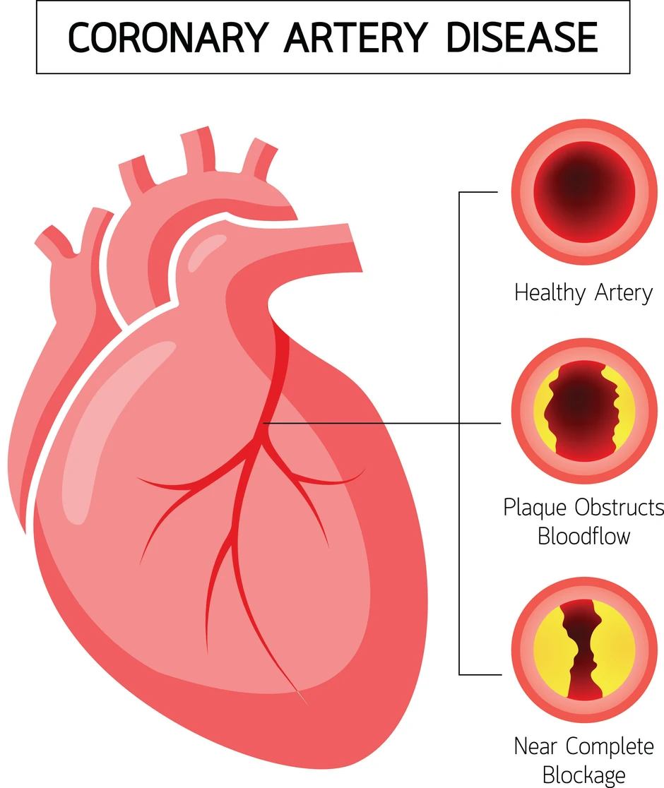 (Odozgo na dole) Zdrava arterija, stvaranje plaka i kritično suženje