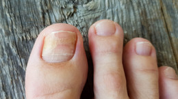 Onycholiza paznokcia - objawy i leczenie choroby