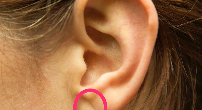 An earlobe crease is a diagonal fold on the lobe.MagMos/Getty Images