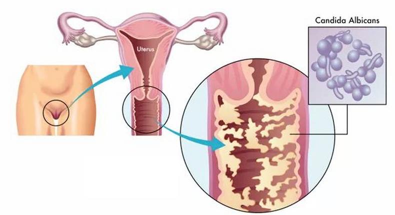 5 signes majeurs qui montrent que vous avez une infection vaginale/Roberto Biasini - 123R