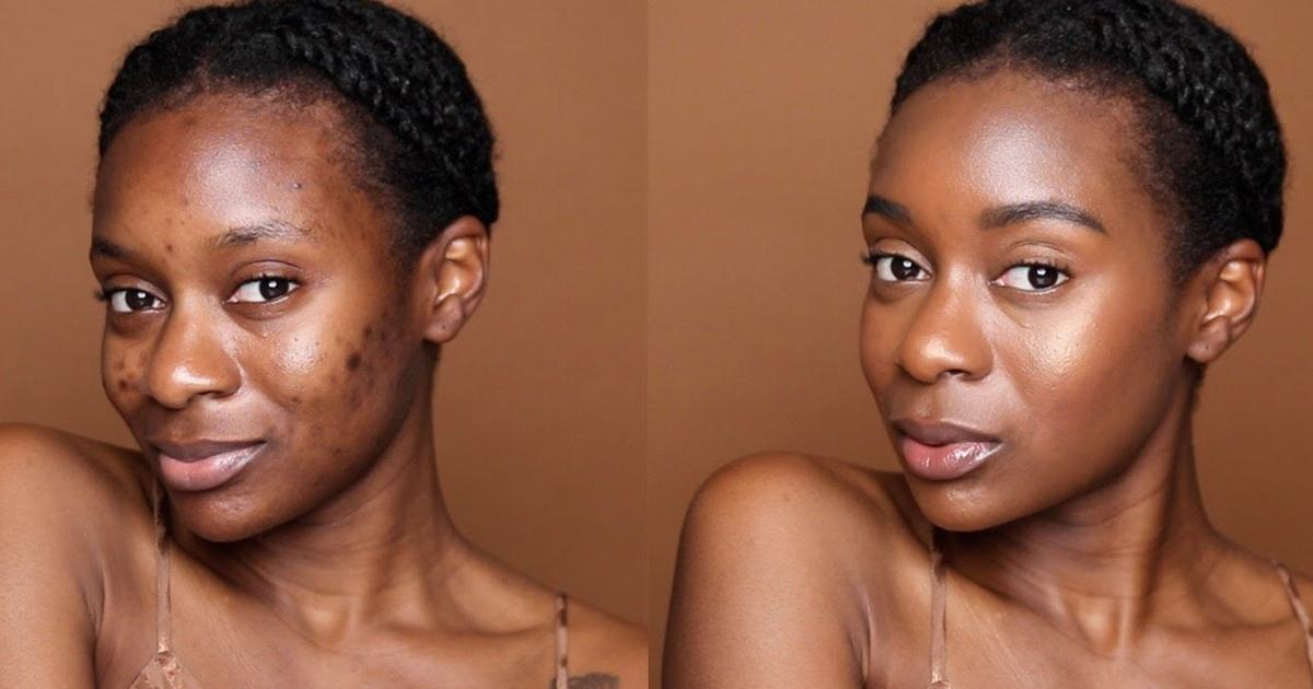 Pimple-free skin for under ₦6,000? Kiss pimples goodbye with these 5 products - Vimarsana News