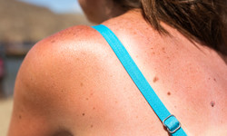 Czy stosowanie kremów z filtrem UV zmniejsza ryzyko czerniaka?