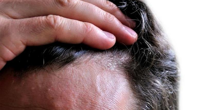 Dandruff is usually caused by dry scalp