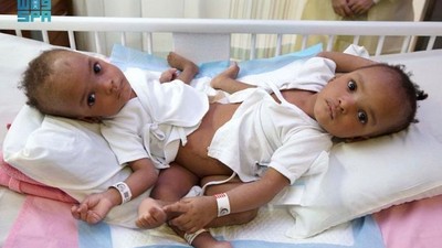 The Nigerian conjoined twins, Hassana and Hussaina are currently in a separation surgery [Arab News]