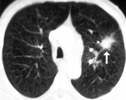 ct-tudotumor-d00000E8F9e54e42789ba