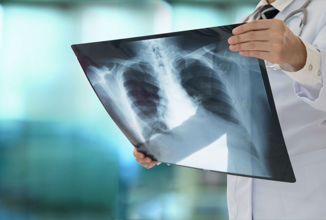 Od kancera pluća godišnje oboli oko dva miliona ljudi