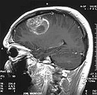 glioblastoma-d0000118B2f96ac84c8e1