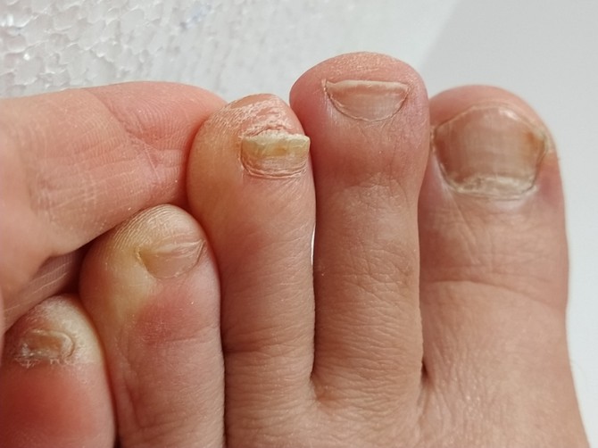 Dermatolog tvrdi da gljivice nestaju ako potopite stopala 2 puta dnevno u ovu kupku! 