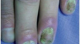 Drożdżyca płytek i wałów paznokci - przyczyny, objawy, rozpoznanie i leczenie