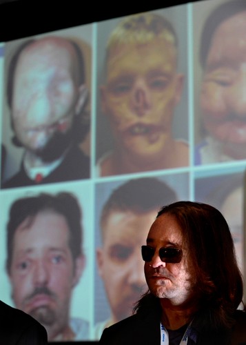 Dallas Wiens. Przeszedł przeszczep twarzy