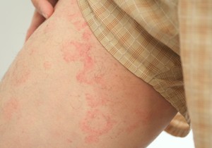 Osip na unutrašnjoj strani butina