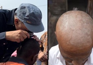 Biopsije i analize krvi urađene su nekim ljudima da se ustanovi da li je gubitak kose uzrokovan gljivičnim infekcijama | Foto: BBC