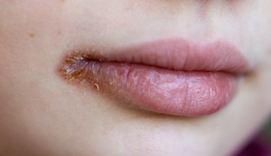 Žvale su ograničene na uglove usta i ne proizvode plikove 